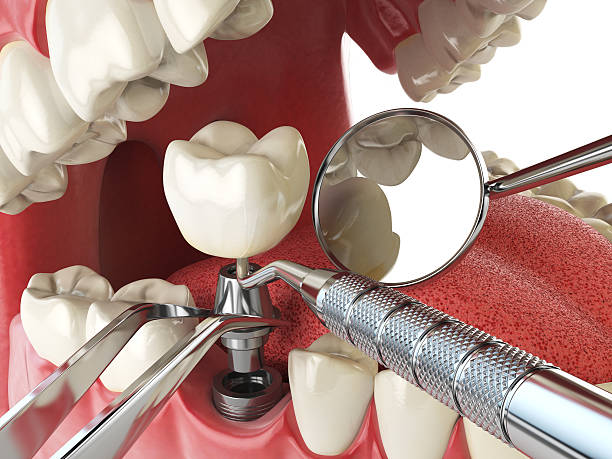 Best Emergency Wisdom Teeth Removal in East Brady, PA
